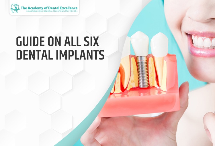 GUIDE ON ALL SIX DENTAL IMPLANTS