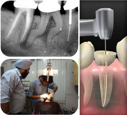 endodontic courses in india